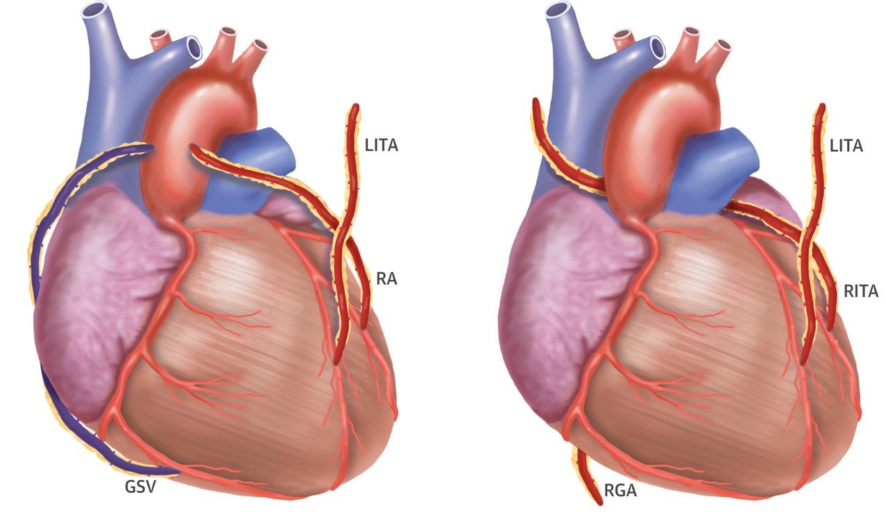 Coronary artery bypass surgeries