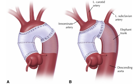Aortic arch replacement